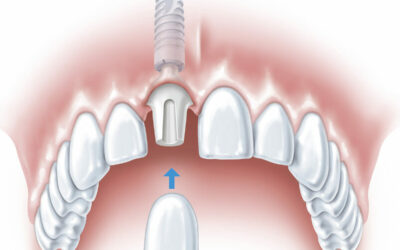 Co obejmuje implantologia zębów?