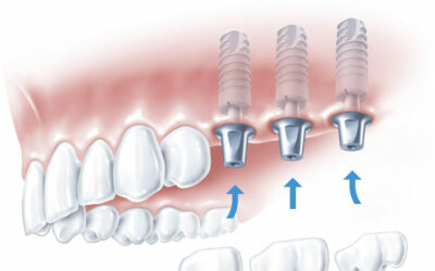 Kto może skorzystać z implantów zębowych i jakie są wymagania dla pacjentów?